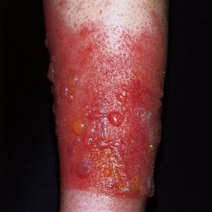 Phototoxische Dermatitis mit Johanniskraut