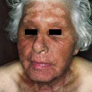 Phototoxische Dermatitis und Kosmetikum